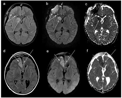 Cerebral Infarction in Childhood-Onset Craniopharyngioma Patients: Results of KRANIOPHARYNGEOM 2007